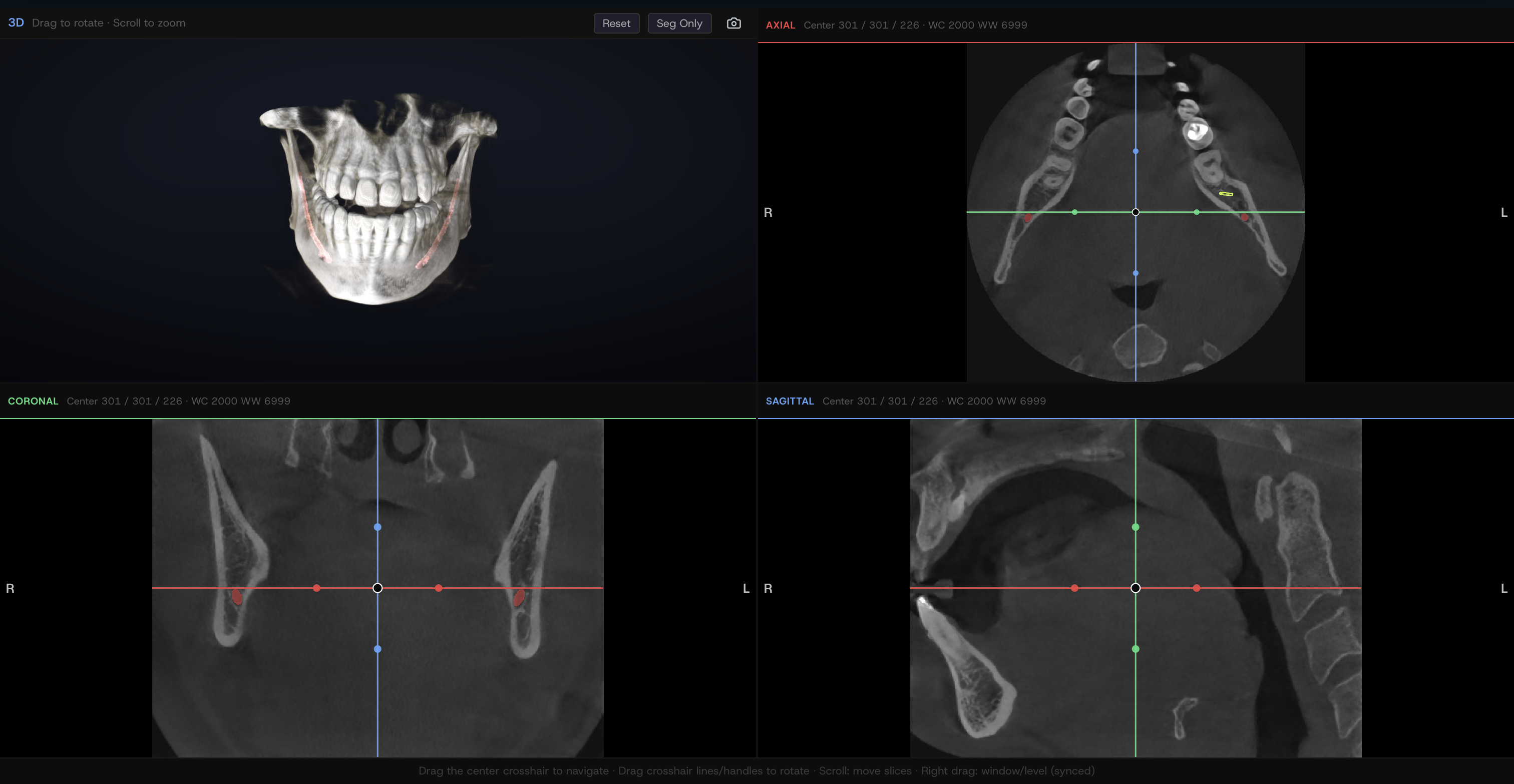 MPR Reconstruction